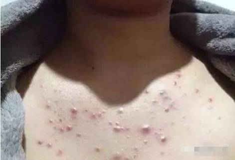 背部长痘痘是什么原因