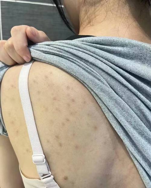 背部长痘痘是什么原因