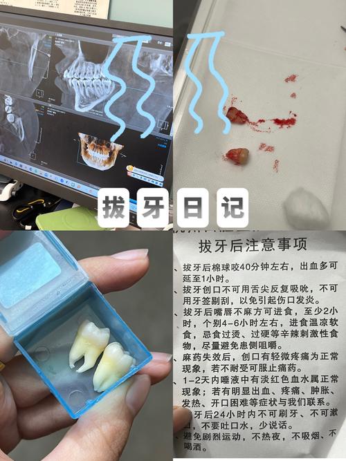 什么情况下可以拔牙