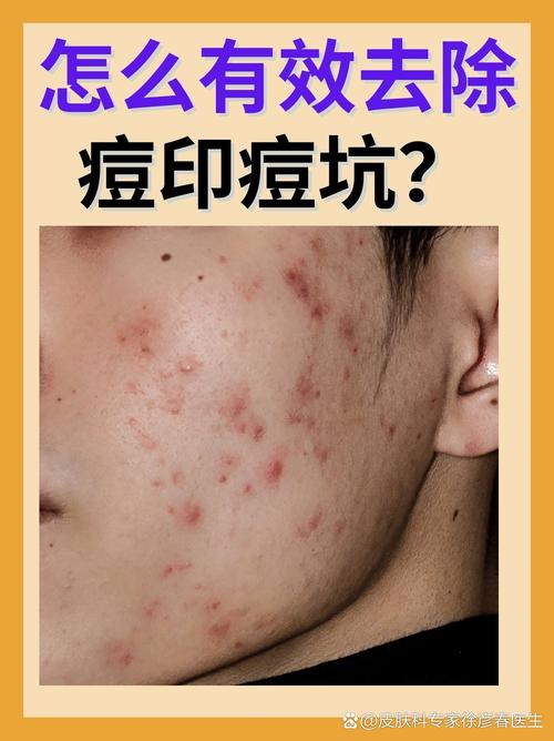 用什么可以去除痘印
