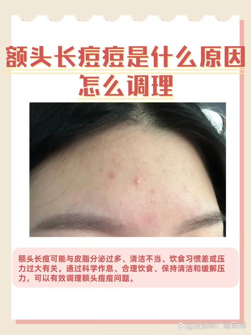 为什么额头老是长痘