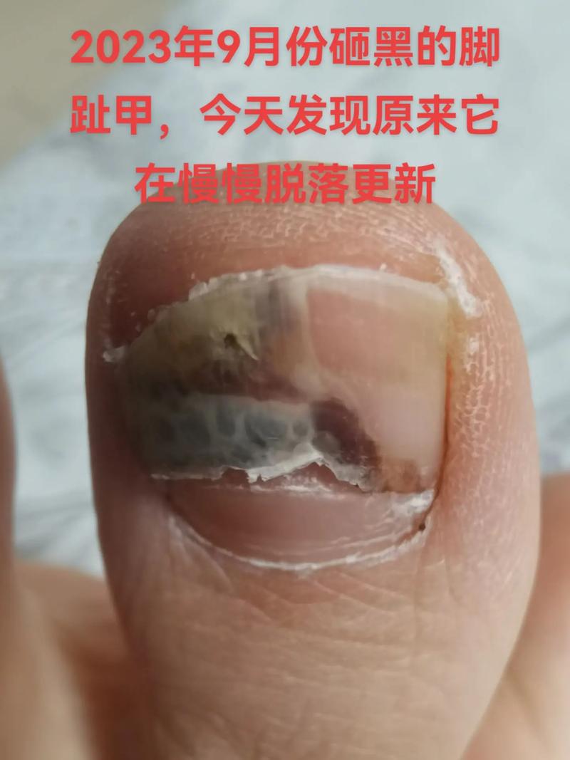 脚指甲为什么会脱落