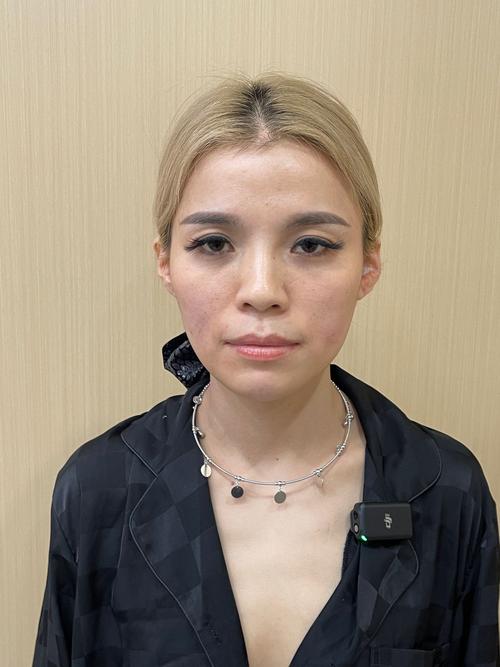 填充面部用什么最好