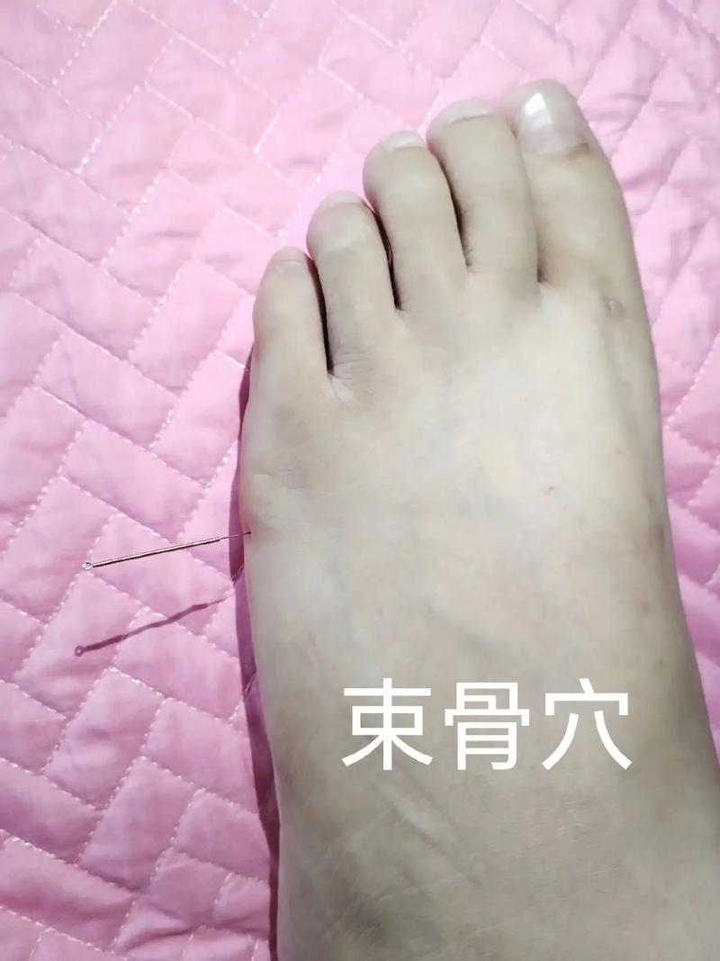 什么是扎骨