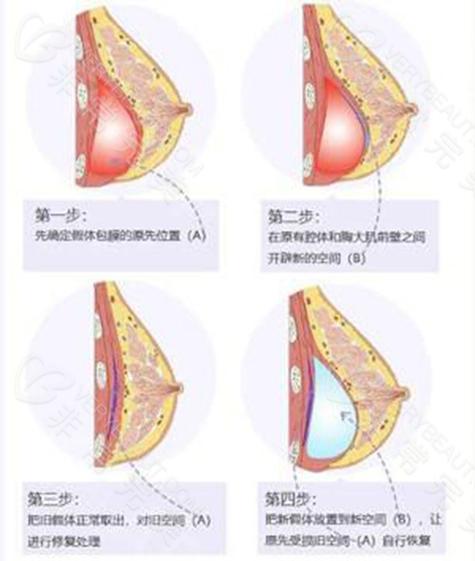 什么是包膜挛缩