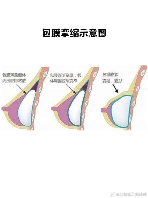 什么是包膜挛缩