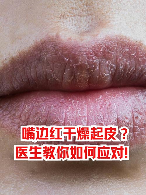 嘴唇干起皮是什么原因