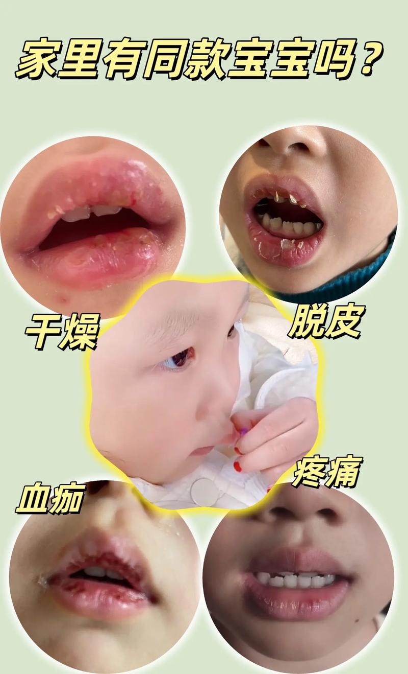 嘴唇干起皮是什么原因