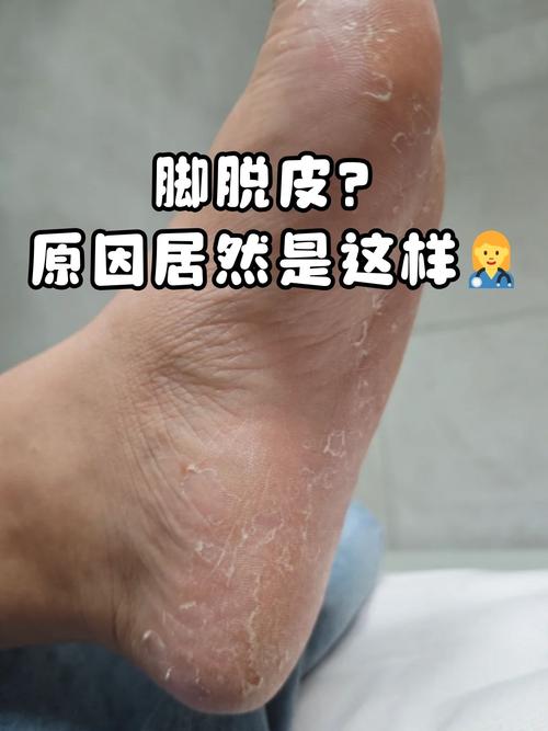 脚干脱皮是什么原因
