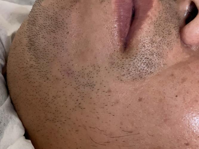 为什么胡子越刮越多