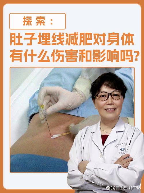 什么人不能埋线减肥