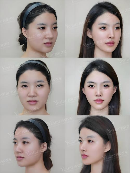 什么是颧骨外扩