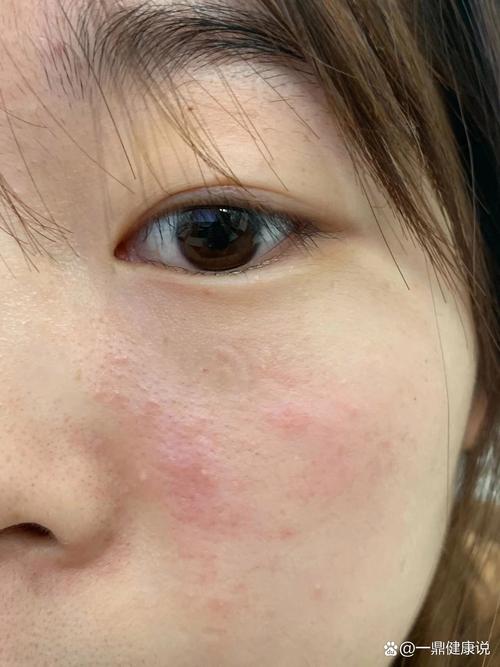 脸上为什么老是过敏