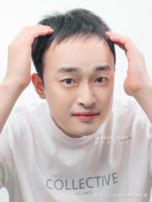 秃顶剪什么发型好看