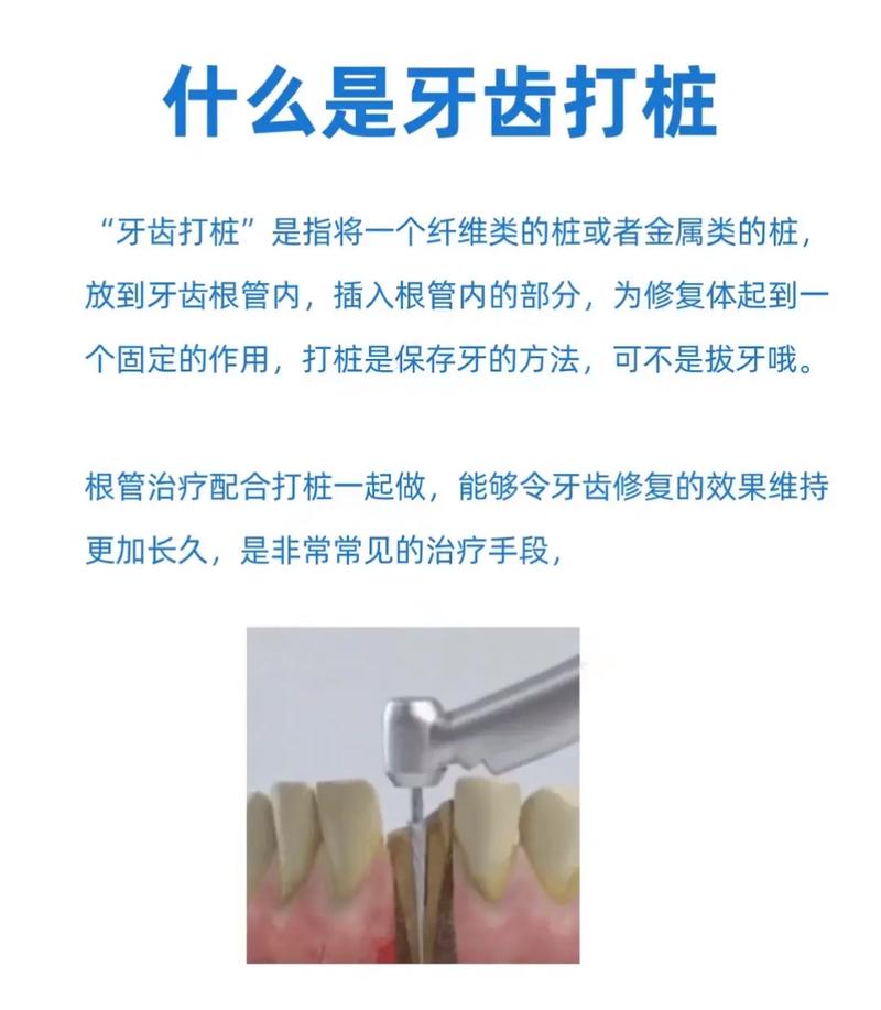 牙齿打桩什么意思