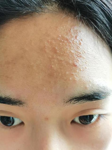 什么是皮肤闭口