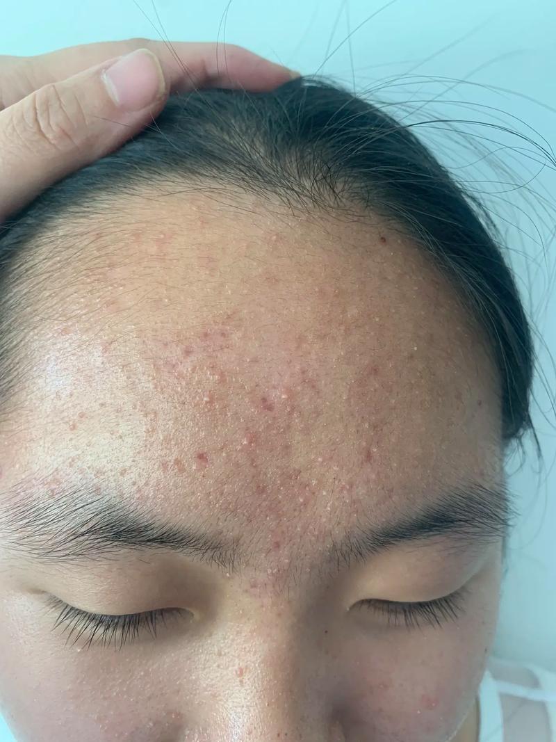 什么是皮肤闭口