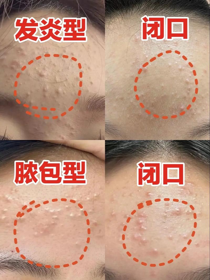 什么是皮肤闭口