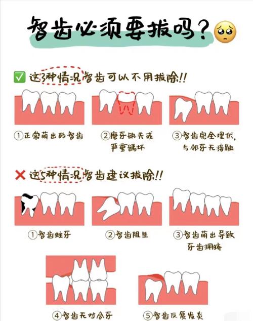 智齿什么情况下要拔