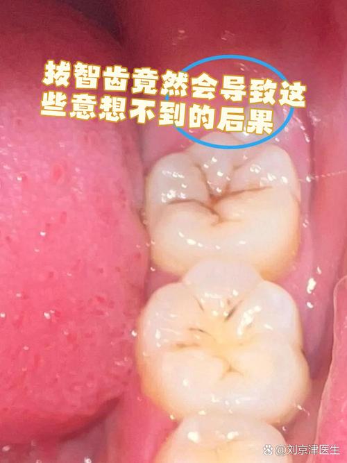 智齿什么情况下要拔
