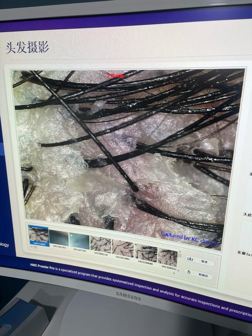 头上为什么有头皮屑