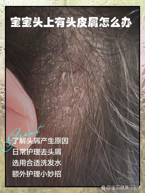 头上为什么有头皮屑