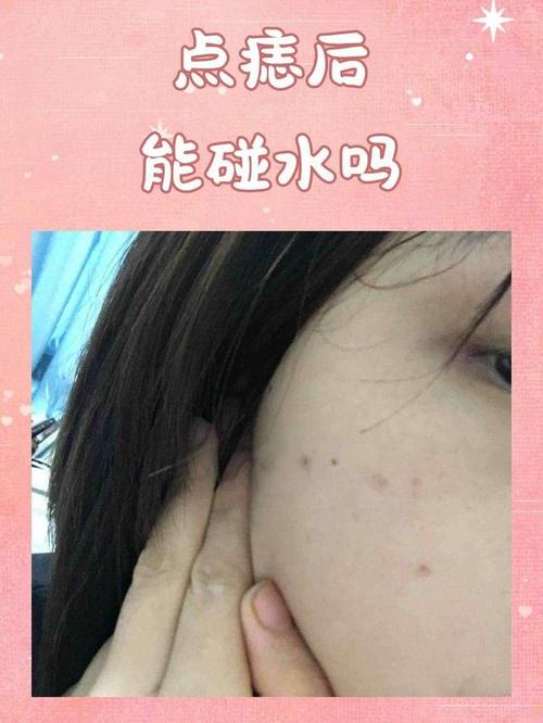 点痣为什么不能碰水