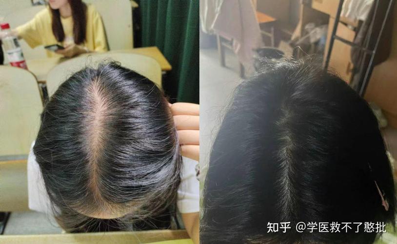 头发少是因为什么
