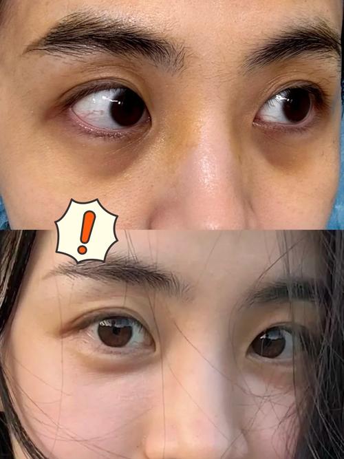 眼角凹陷是什么原因