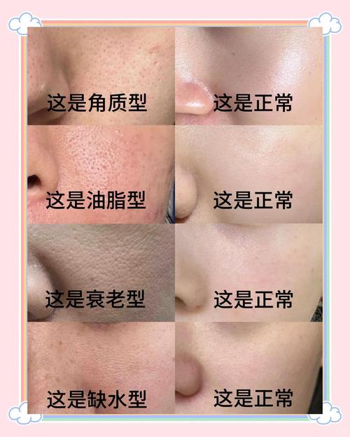 脸上为什么会有毛孔