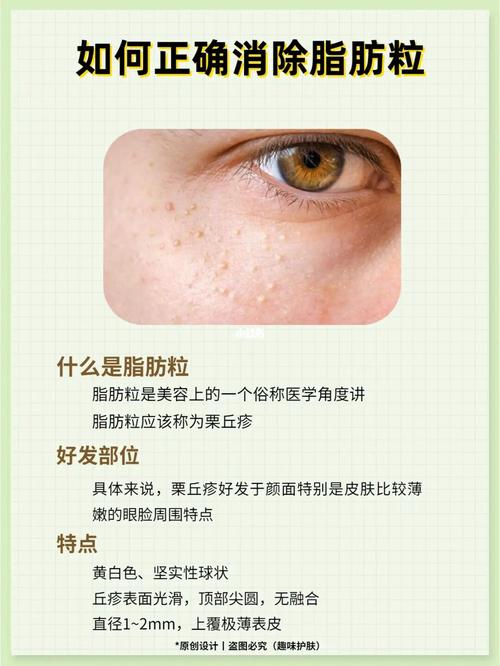 什么去脂肪粒