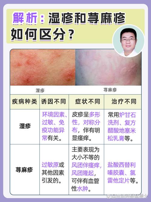 湿疹属于什么科