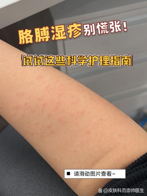 湿疹属于什么科