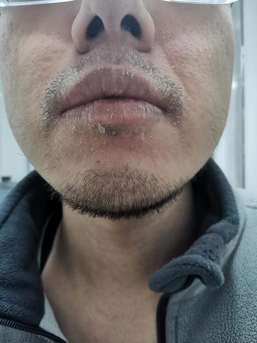 嘴唇起干皮是什么原因