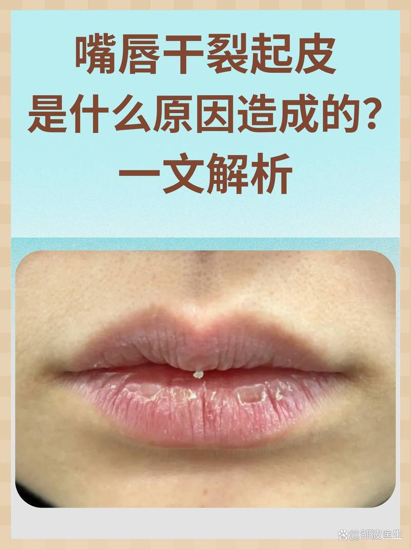 嘴唇起干皮是什么原因