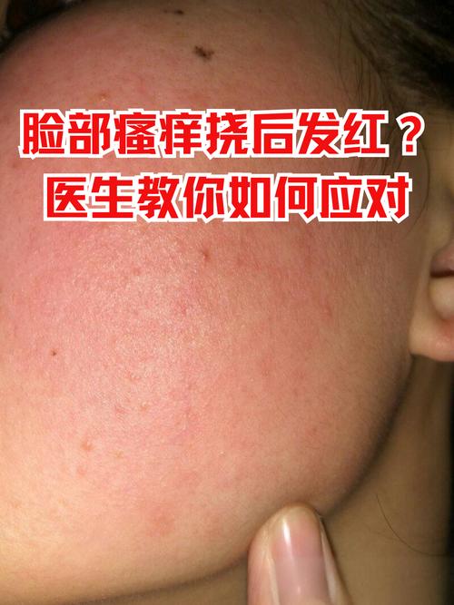 脸部过敏不能吃什么