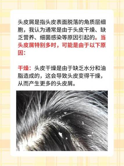 长头屑是什么原因