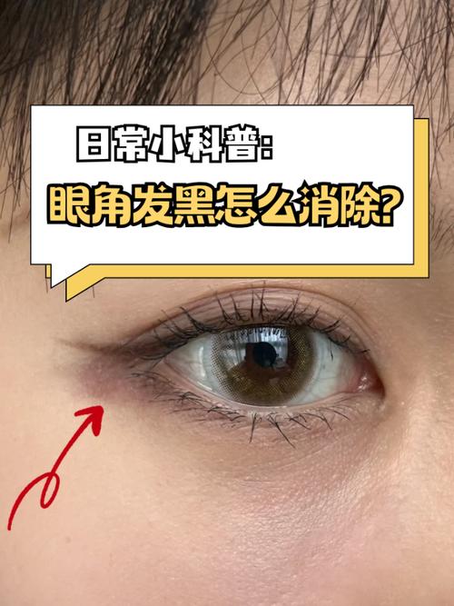 眼角黑斑是什么原因