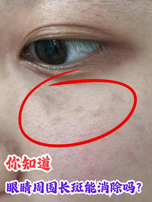 眼角黑斑是什么原因