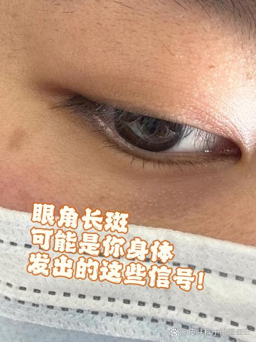 眼角黑斑是什么原因