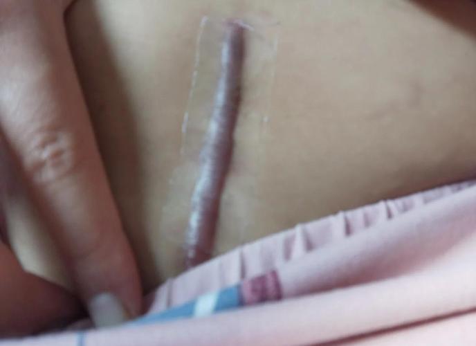 皮肤增生用什么药膏