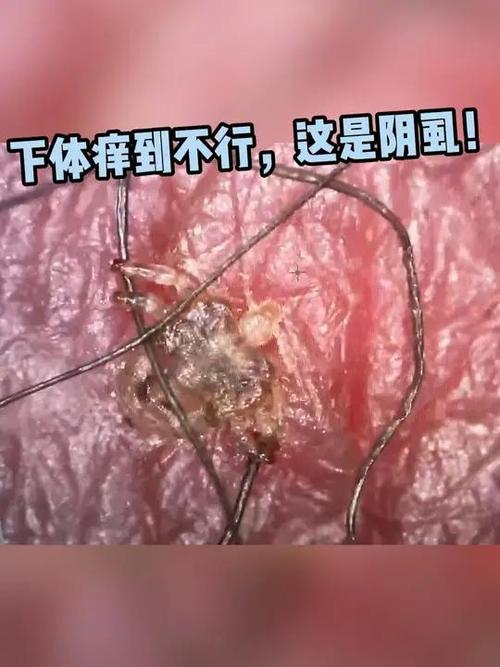 阴虱是什么东西