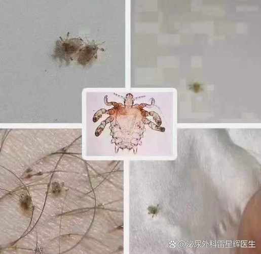阴虱是什么东西