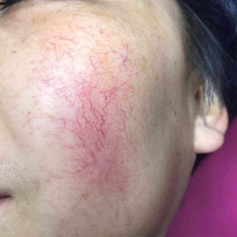 脸上为什么会有血丝