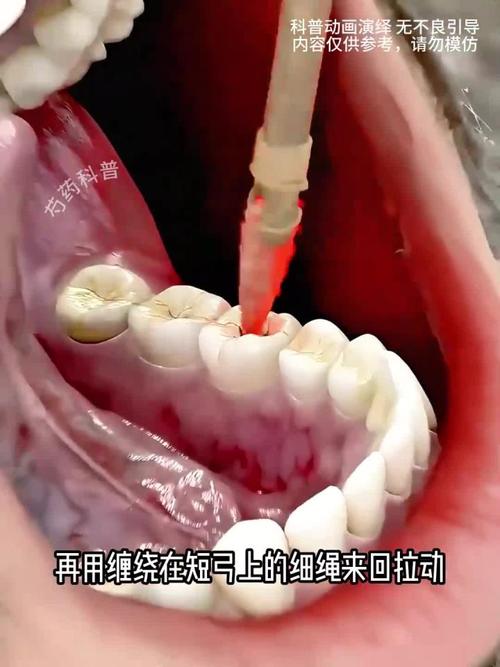 钻牙是什么