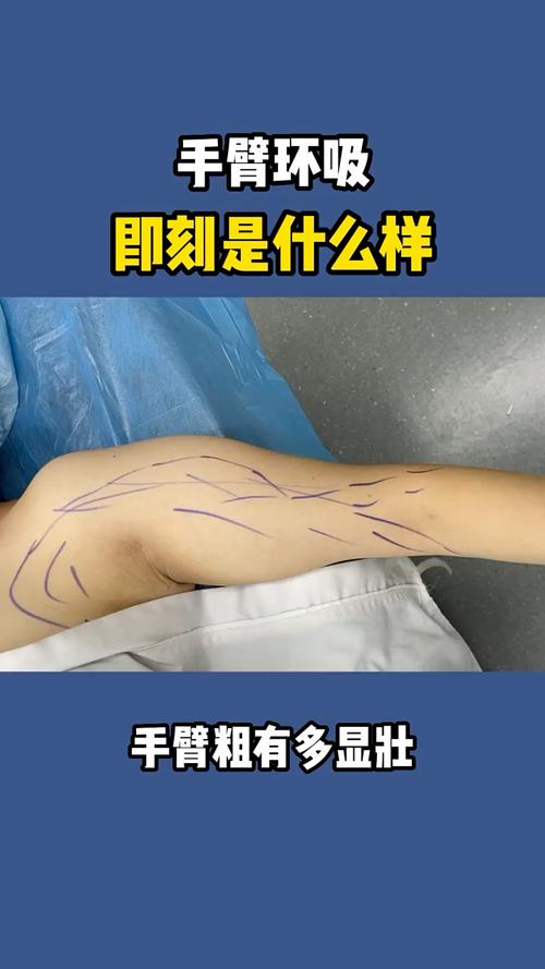什么是环吸