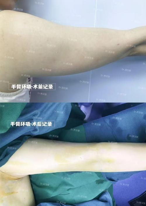 什么是环吸