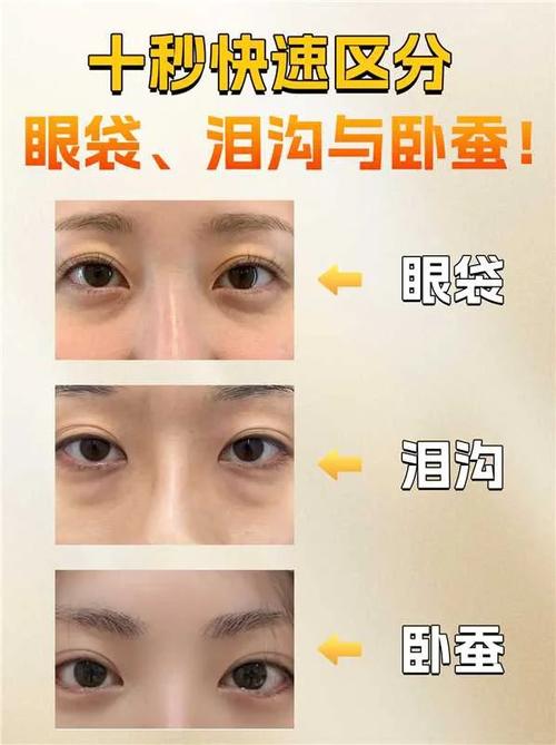 什么是卧蚕什么是眼袋