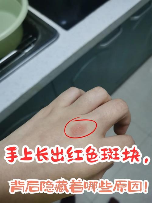 为什么手上会长斑