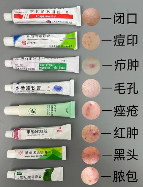 闭口粉刺擦什么药膏